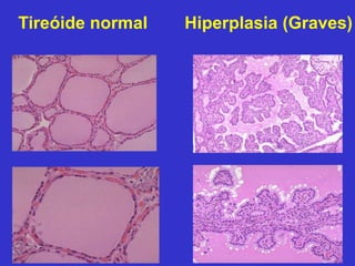 Tireóide normal Hiperplasia (Graves) 
 