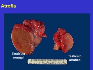 Atrofia 
Testículo 
normal Testículo 
atrófico 
 