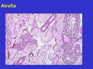 Atrofia 
 