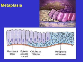 Metaplasia 
 
