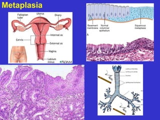 Metaplasia 
 