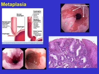 Metaplasia 
