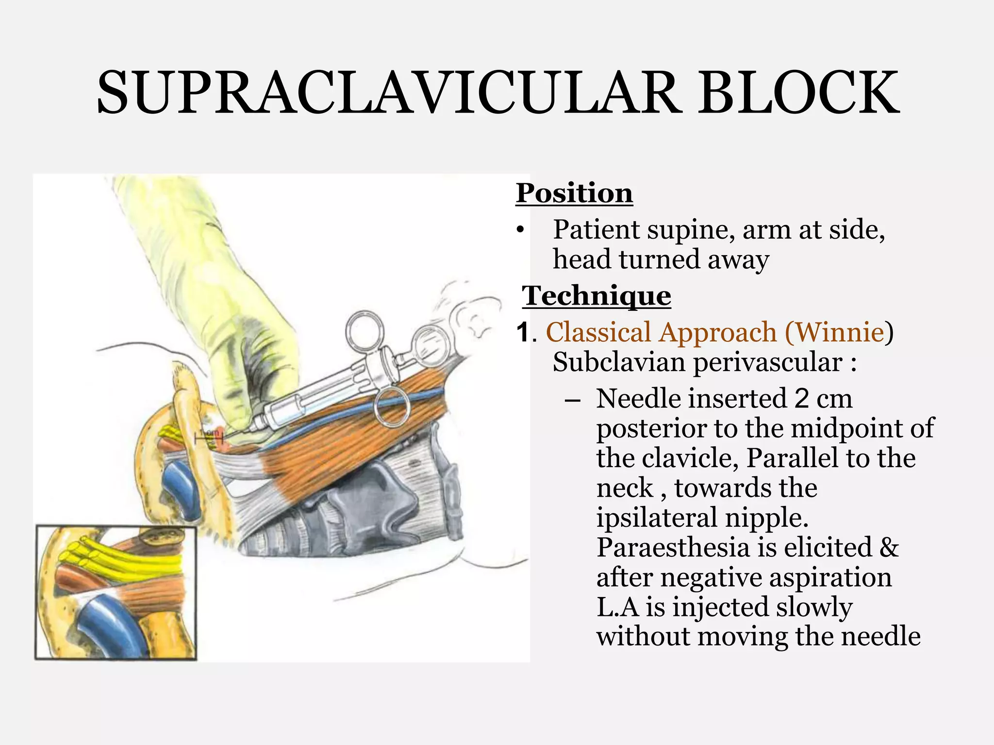 SUPRACLAVICULAR BLOCK
Position
• Patient supine, arm at side,
head turned away
Technique
1. Classical Approach (Winnie)
Subclavian perivascular :
– Needle inserted 2 cm
posterior to the midpoint of
the clavicle, Parallel to the
neck , towards the
ipsilateral nipple.
Paraesthesia is elicited &
after negative aspiration
L.A is injected slowly
without moving the needle
 