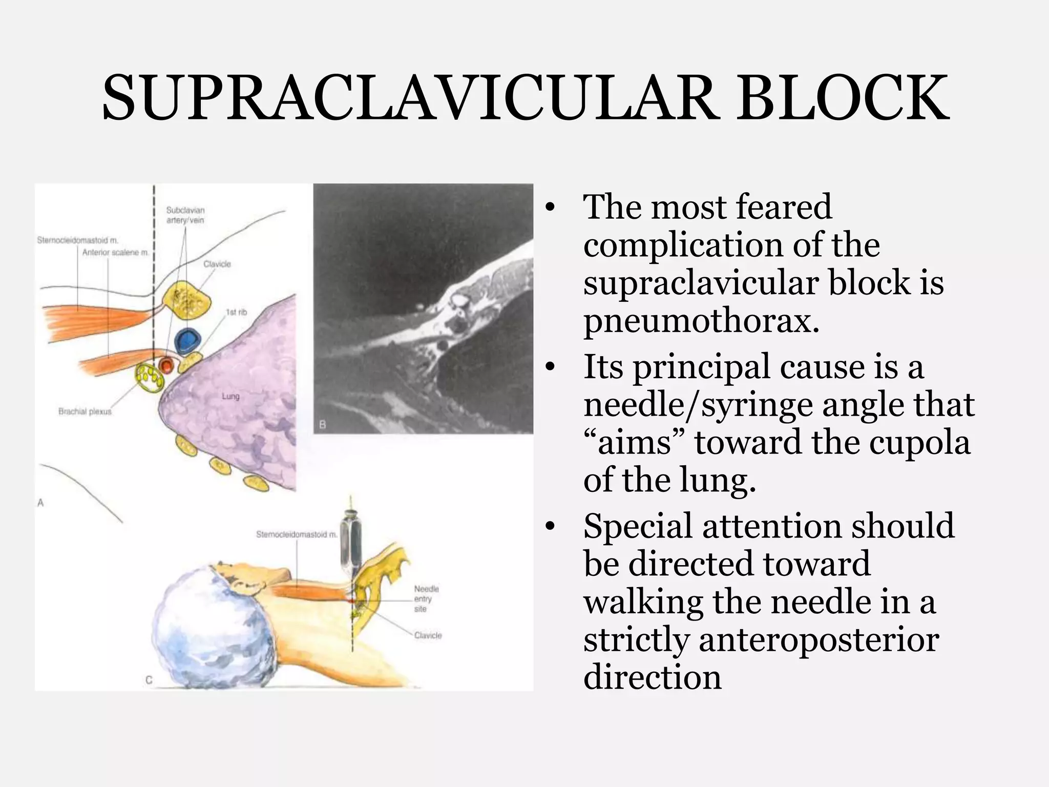 SUPRACLAVICULAR BLOCK
• The most feared
complication of the
supraclavicular block is
pneumothorax.
• Its principal cause is a
needle/syringe angle that
“aims” toward the cupola
of the lung.
• Special attention should
be directed toward
walking the needle in a
strictly anteroposterior
direction
 