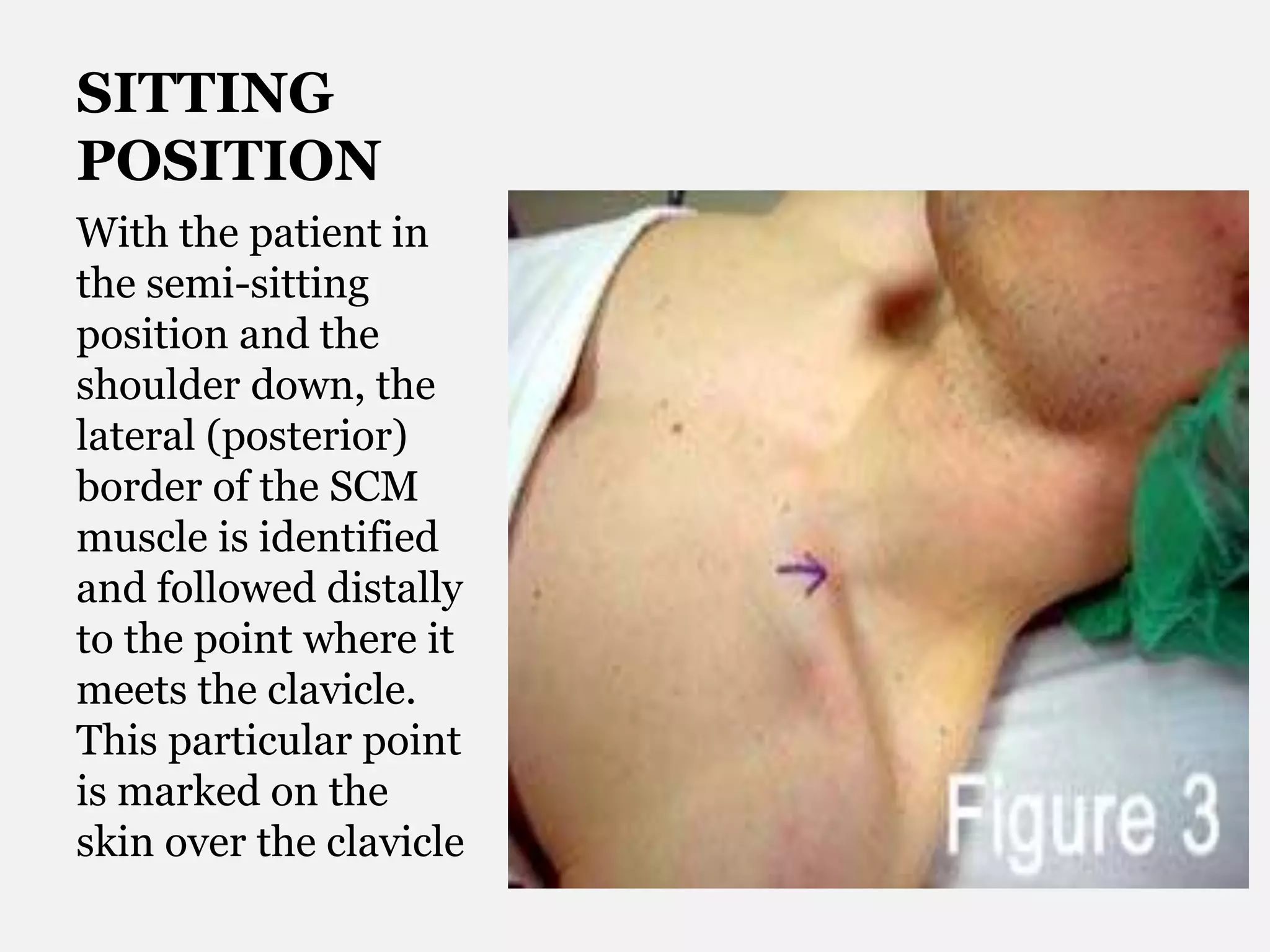 SITTING
POSITION
With the patient in
the semi-sitting
position and the
shoulder down, the
lateral (posterior)
border of the SCM
muscle is identified
and followed distally
to the point where it
meets the clavicle.
This particular point
is marked on the
skin over the clavicle
 