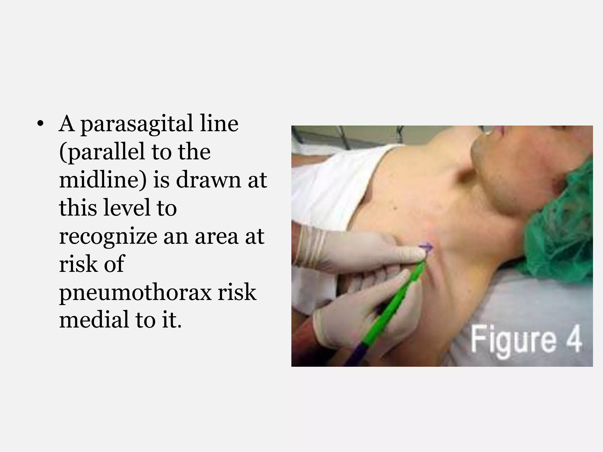 • A parasagital line
(parallel to the
midline) is drawn at
this level to
recognize an area at
risk of
pneumothorax risk
medial to it.
 