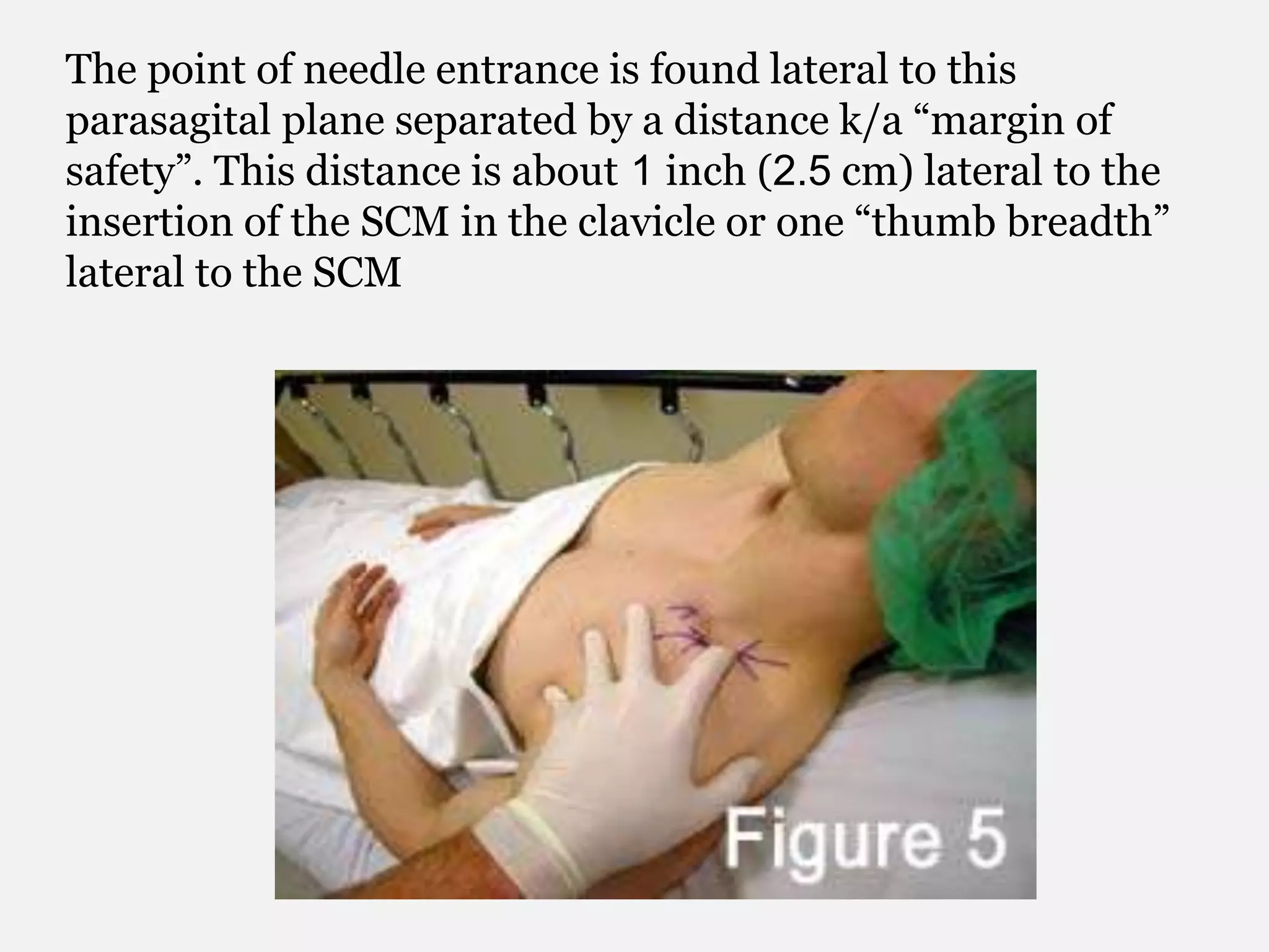 The point of needle entrance is found lateral to this
parasagital plane separated by a distance k/a “margin of
safety”. This distance is about 1 inch (2.5 cm) lateral to the
insertion of the SCM in the clavicle or one “thumb breadth”
lateral to the SCM
 