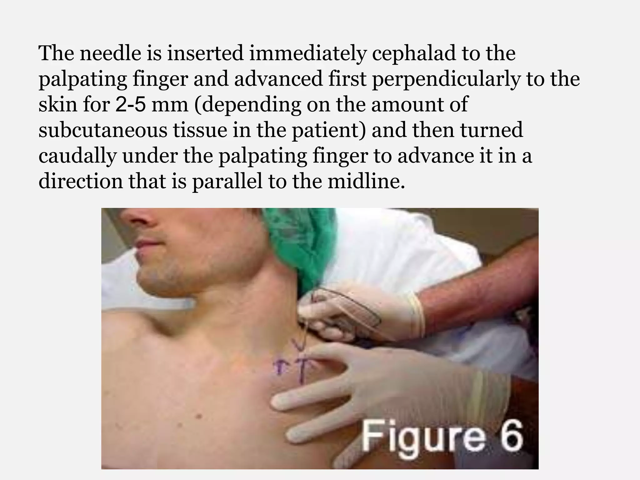 The needle is inserted immediately cephalad to the
palpating finger and advanced first perpendicularly to the
skin for 2-5 mm (depending on the amount of
subcutaneous tissue in the patient) and then turned
caudally under the palpating finger to advance it in a
direction that is parallel to the midline.
 