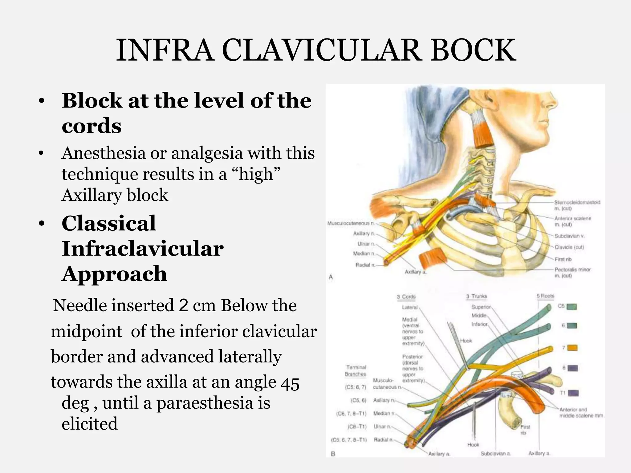 INFRA CLAVICULAR BOCK
• Block at the level of the
cords
• Anesthesia or analgesia with this
technique results in a “high”
Axillary block
• Classical
Infraclavicular
Approach
Needle inserted 2 cm Below the
midpoint of the inferior clavicular
border and advanced laterally
towards the axilla at an angle 45
deg , until a paraesthesia is
elicited
 