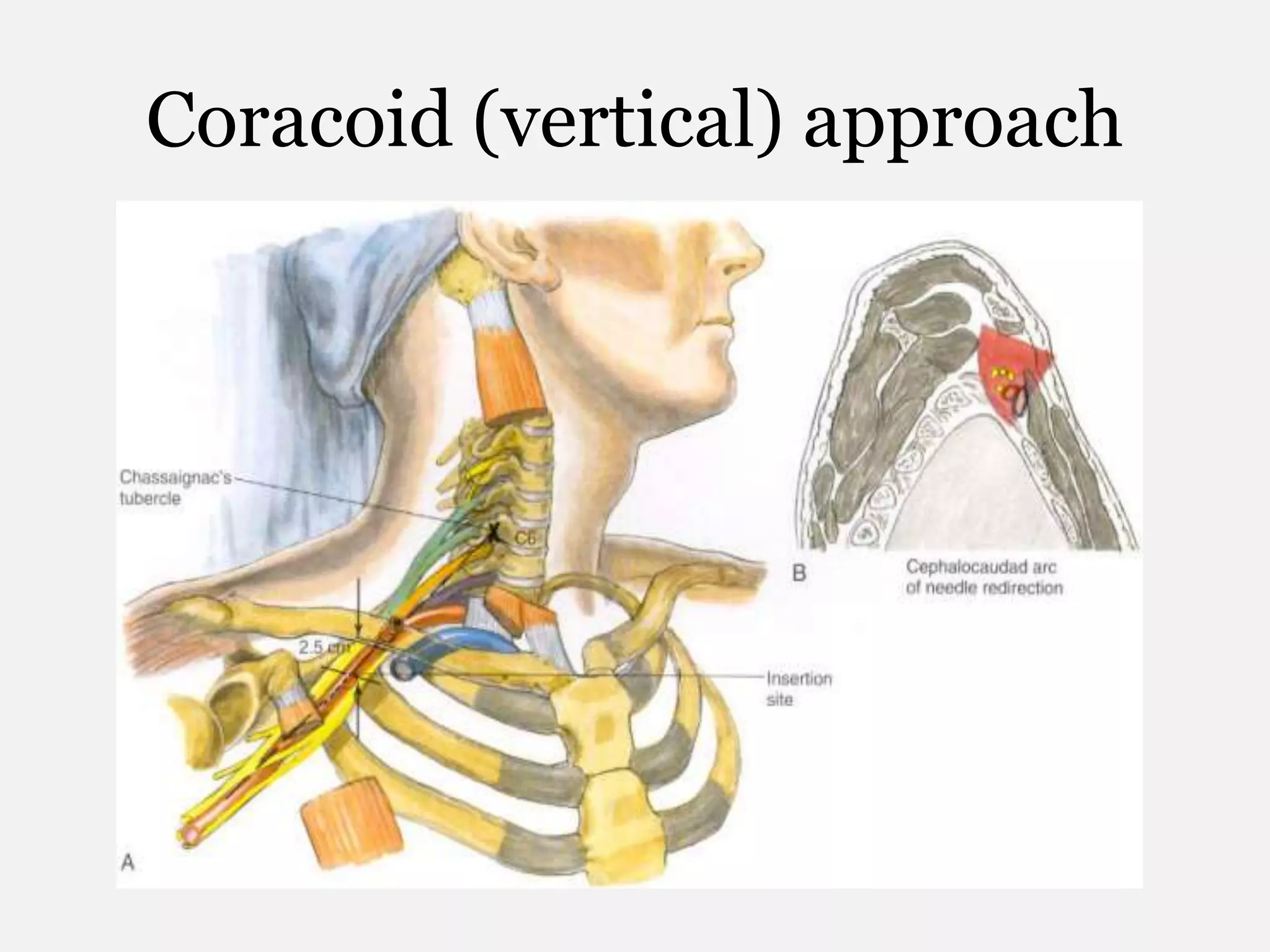 Coracoid (vertical) approach
 