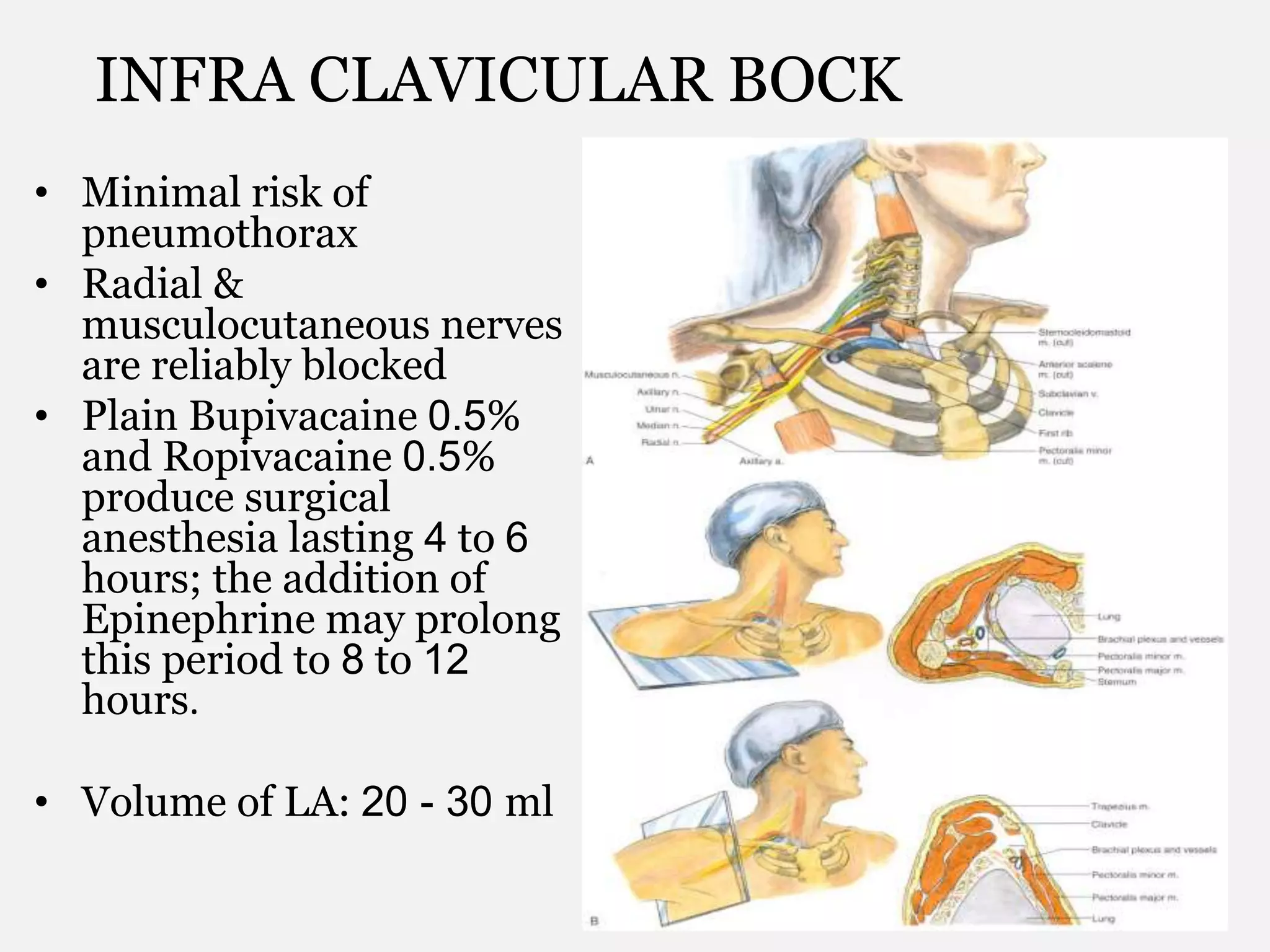 INFRA CLAVICULAR BOCK
• Minimal risk of
pneumothorax
• Radial &
musculocutaneous nerves
are reliably blocked
• Plain Bupivacaine 0.5%
and Ropivacaine 0.5%
produce surgical
anesthesia lasting 4 to 6
hours; the addition of
Epinephrine may prolong
this period to 8 to 12
hours.
• Volume of LA: 20 - 30 ml
 