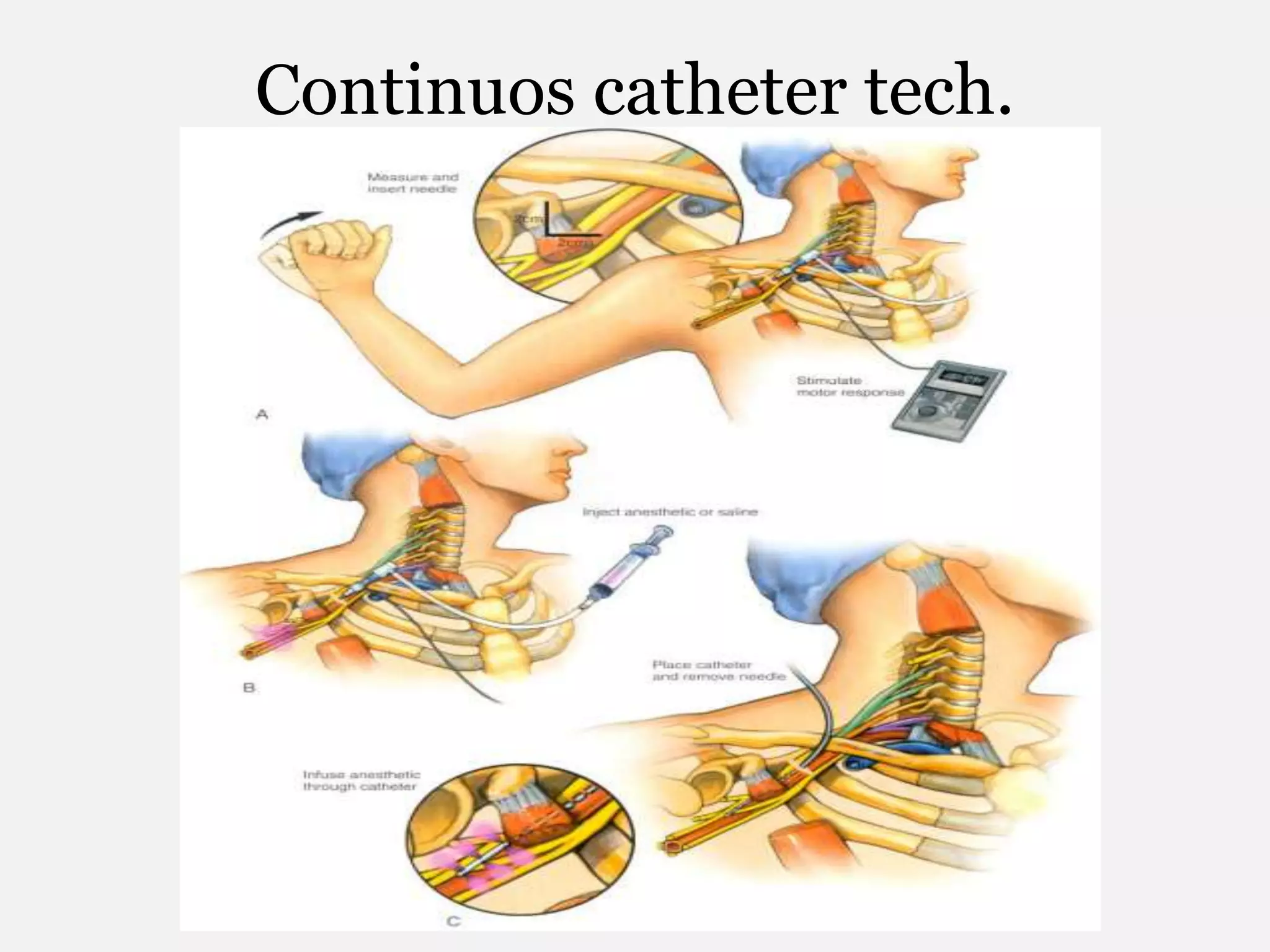Continuos catheter tech.
 