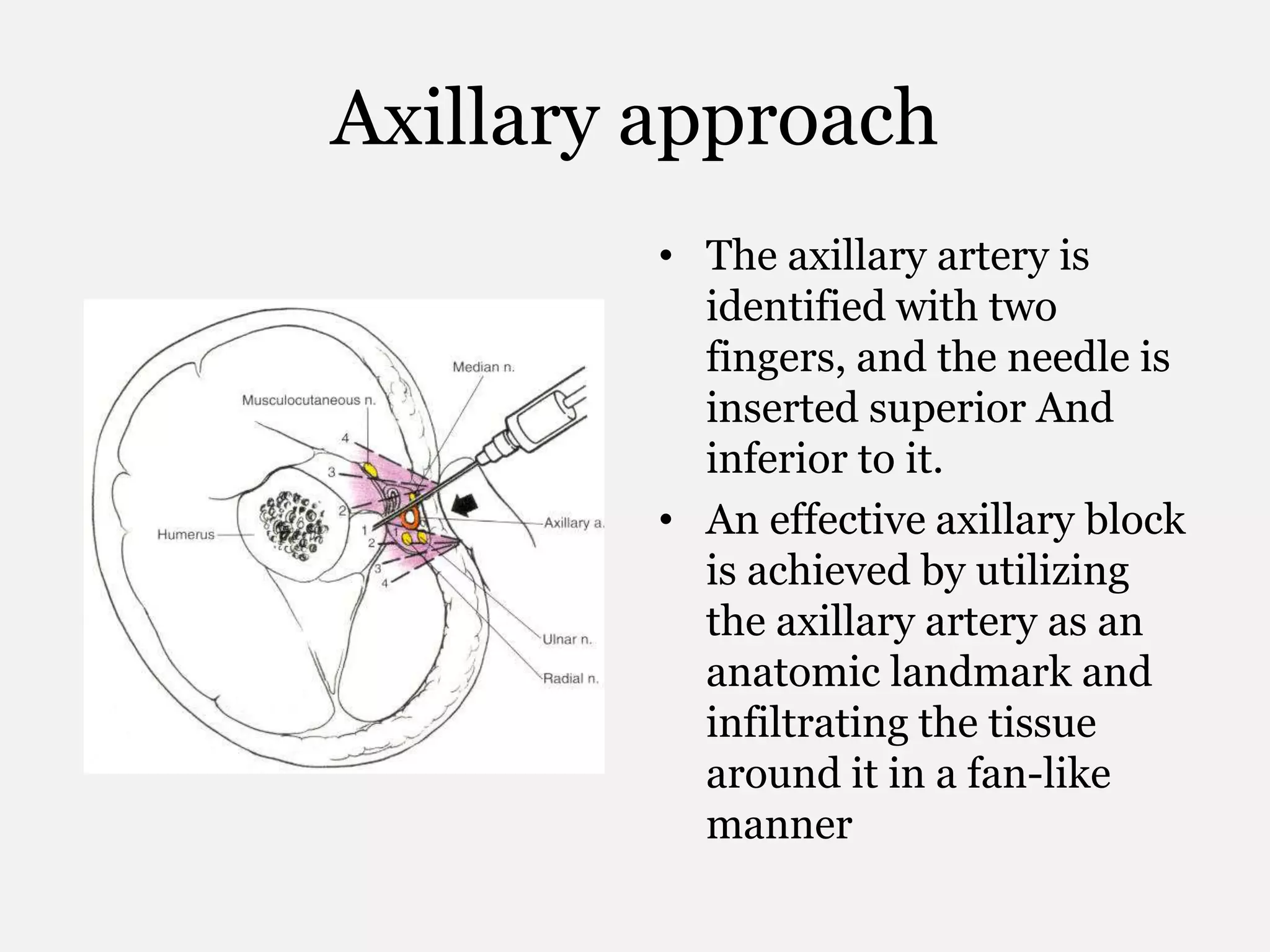 Axillary approach
• The axillary artery is
identified with two
fingers, and the needle is
inserted superior And
inferior to it.
• An effective axillary block
is achieved by utilizing
the axillary artery as an
anatomic landmark and
infiltrating the tissue
around it in a fan-like
manner
 