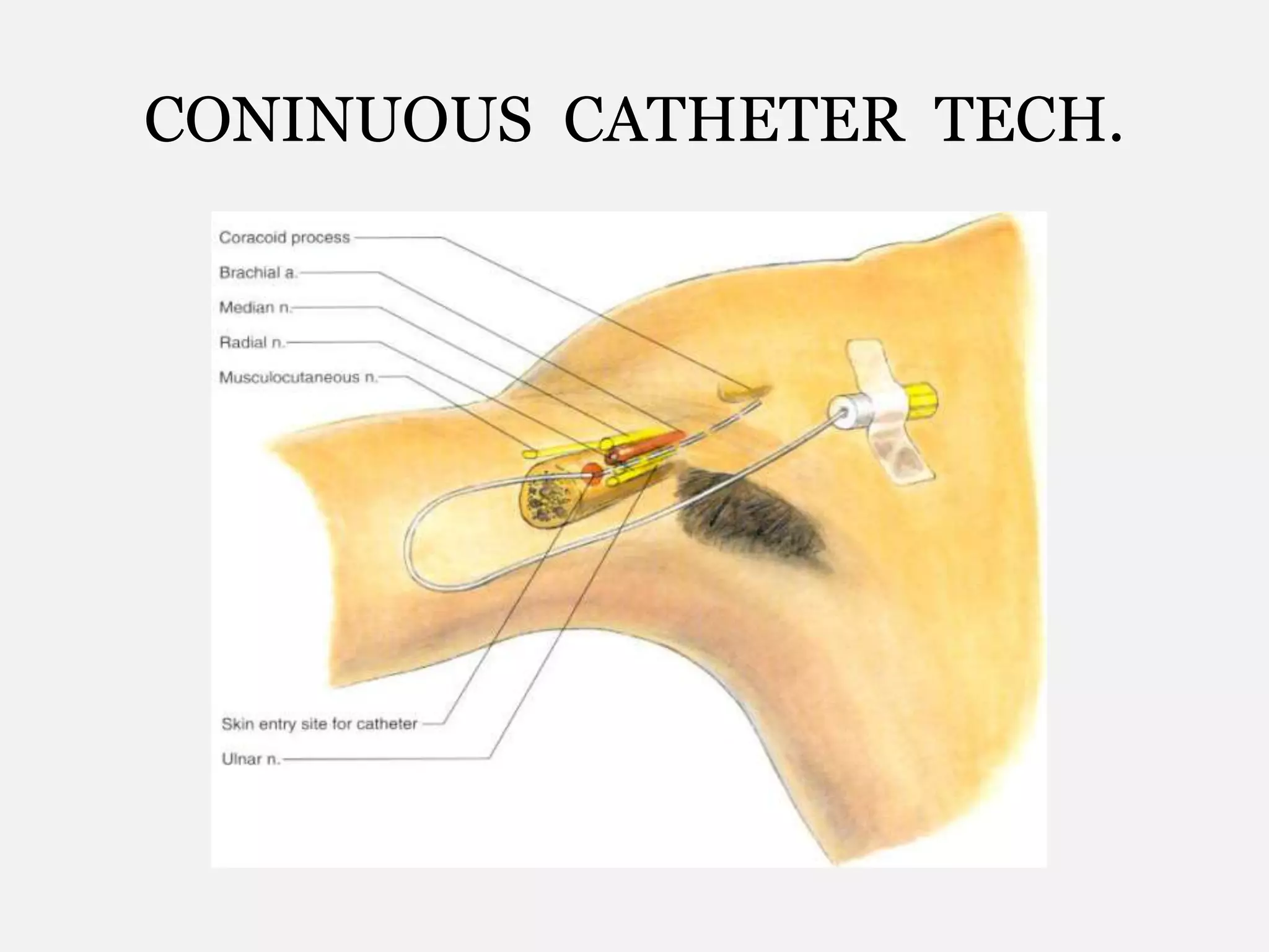CONINUOUS CATHETER TECH.
 