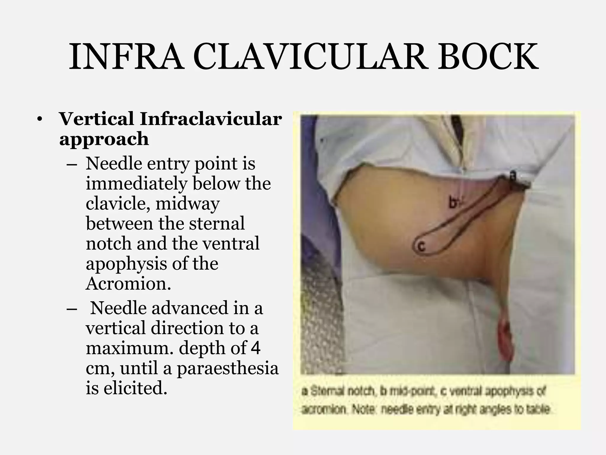 INFRA CLAVICULAR BOCK
• Vertical Infraclavicular
approach
– Needle entry point is
immediately below the
clavicle, midway
between the sternal
notch and the ventral
apophysis of the
Acromion.
– Needle advanced in a
vertical direction to a
maximum. depth of 4
cm, until a paraesthesia
is elicited.
 