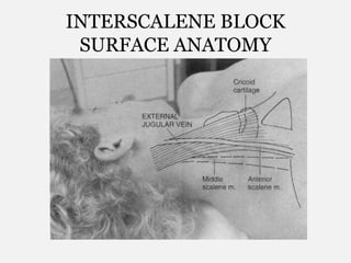 INTERSCALENE BLOCK
SURFACE ANATOMY
 