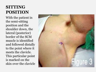 SITTING
POSITION
With the patient in
the semi-sitting
position and the
shoulder down, the
lateral (posterior)
border of the SCM
muscle is identified
and followed distally
to the point where it
meets the clavicle.
This particular point
is marked on the
skin over the clavicle
 