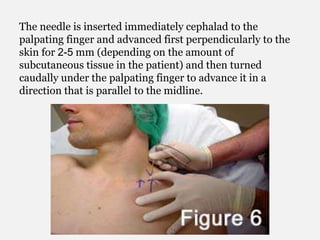 The needle is inserted immediately cephalad to the
palpating finger and advanced first perpendicularly to the
skin for 2-5 mm (depending on the amount of
subcutaneous tissue in the patient) and then turned
caudally under the palpating finger to advance it in a
direction that is parallel to the midline.
 