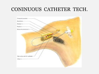 CONINUOUS CATHETER TECH.
 
