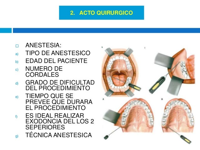 cirugia de terceros molares