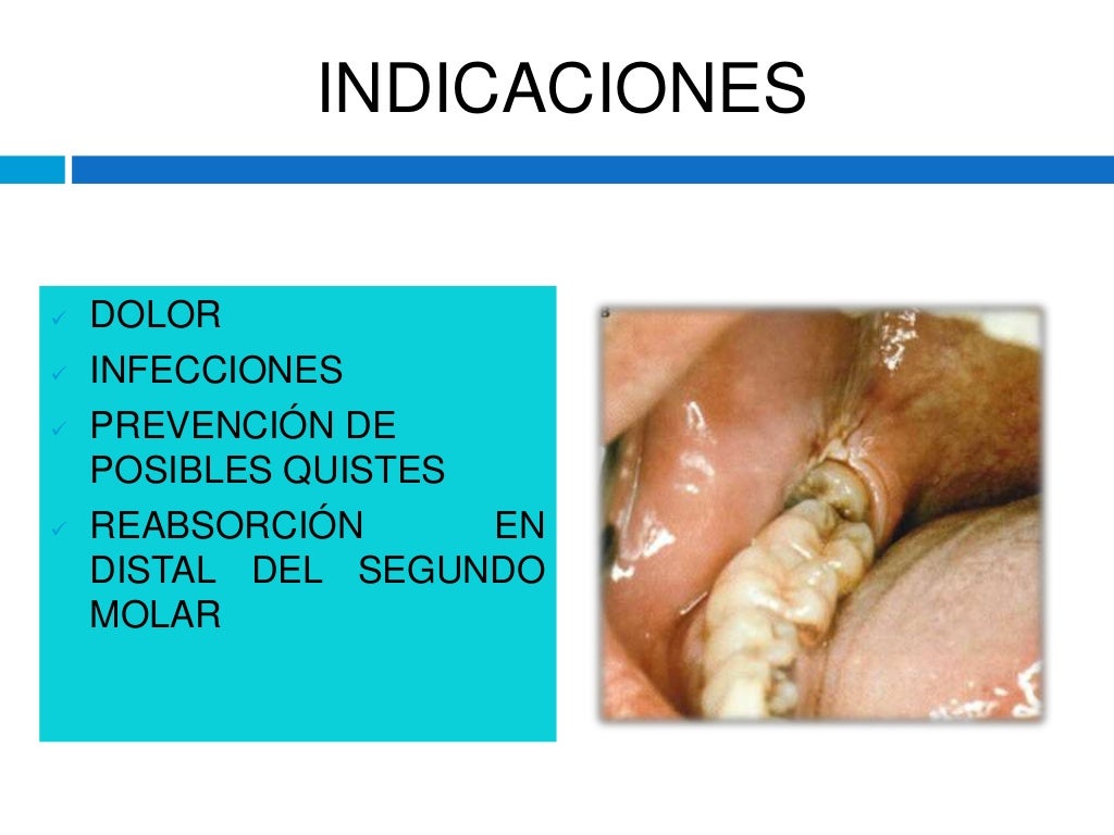cirugia de terceros molares