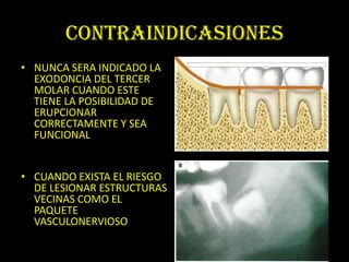 CONTRAINDICASIONES
• NUNCA SERA INDICADO LA
  EXODONCIA DEL TERCER
  MOLAR CUANDO ESTE
  TIENE LA POSIBILIDAD DE
  ERUPCIONAR
  CORRECTAMENTE Y SEA
  FUNCIONAL


• CUANDO EXISTA EL RIESGO
  DE LESIONAR ESTRUCTURAS
  VECINAS COMO EL
  PAQUETE
  VASCULONERVIOSO
 
