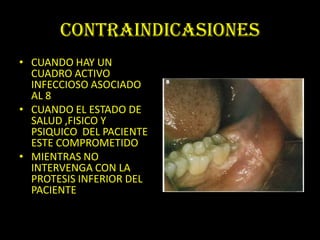 CONTRAINDICASIONES
• CUANDO HAY UN
  CUADRO ACTIVO
  INFECCIOSO ASOCIADO
  AL 8
• CUANDO EL ESTADO DE
  SALUD ,FISICO Y
  PSIQUICO DEL PACIENTE
  ESTE COMPROMETIDO
• MIENTRAS NO
  INTERVENGA CON LA
  PROTESIS INFERIOR DEL
  PACIENTE
 