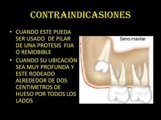 CONTRAINDICASIONES
• CUANDO ESTE PUEDA
  SER USADO DE PILAR
  DE UNA PROTESIS FIJA
  O REMOBIBLE
• CUANDO SU UBICACIÓN
  SEA MUY PROFUNDA Y
  ESTE RODEADO
  ALREDEDOR DE DOS
  CENTIMETROS DE
  HUESO POR TODOS LOS
  LADOS
 