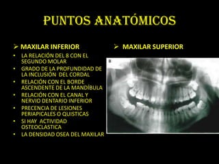 PUNTOS ANATÓMICOS
 MAXILAR INFERIOR                MAXILAR SUPERIOR
• LA RELACIÓN DEL 8 CON EL
  SEGUNDO MOLAR
• GRADO DE LA PROFUNDIDAD DE
  LA INCLUSIÓN DEL CORDAL
• RELACIÓN CON EL BORDE
  ASCENDENTE DE LA MANDÍBULA
• RELACIÓN CON EL CANAL Y
  NERVIO DENTARIO INFERIOR
• PRECENCIA DE LESIONES
  PERIAPICALES O QUISTICAS
• SI HAY ACTIVIDAD
  OSTEOCLASTICA
• LA DENSIDAD OSEA DEL MAXILAR
 