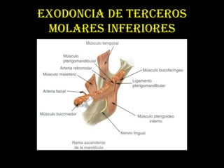 EXODONCIA DE TERCEROS
 MOLARES INFERIORES
 