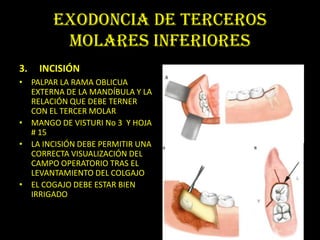 EXODONCIA DE TERCEROS
        MOLARES INFERIORES
3.   INCISIÓN
• PALPAR LA RAMA OBLICUA
  EXTERNA DE LA MANDÍBULA Y LA
  RELACIÓN QUE DEBE TERNER
  CON EL TERCER MOLAR
• MANGO DE VISTURI No 3 Y HOJA
  # 15
• LA INCISIÓN DEBE PERMITIR UNA
  CORRECTA VISUALIZACIÓN DEL
  CAMPO OPERATORIO TRAS EL
  LEVANTAMIENTO DEL COLGAJO
• EL COGAJO DEBE ESTAR BIEN
  IRRIGADO
 