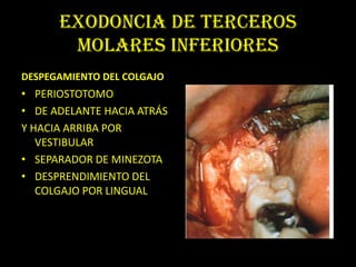 EXODONCIA DE TERCEROS
       MOLARES INFERIORES
DESPEGAMIENTO DEL COLGAJO
• PERIOSTOTOMO
• DE ADELANTE HACIA ATRÁS
Y HACIA ARRIBA POR
   VESTIBULAR
• SEPARADOR DE MINEZOTA
• DESPRENDIMIENTO DEL
   COLGAJO POR LINGUAL
 