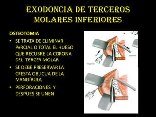 EXODONCIA DE TERCEROS
       MOLARES INFERIORES
OSTEOTOMIA
• SE TRATA DE ELIMINAR
  PARCIAL O TOTAL EL HUESO
  QUE RECUBRE LA CORONA
  DEL TERCER MOLAR
• SE DEBE PRESERVAR LA
  CRESTA OBLICUA DE LA
  MANDÍBULA
• PERFORACIONES Y
  DESPUES SE UNEN
 