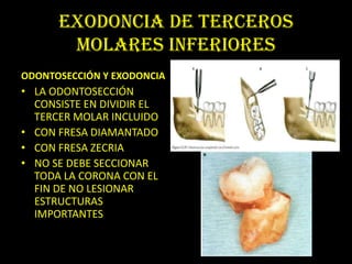 EXODONCIA DE TERCEROS
       MOLARES INFERIORES
ODONTOSECCIÓN Y EXODONCIA
• LA ODONTOSECCIÓN
  CONSISTE EN DIVIDIR EL
  TERCER MOLAR INCLUIDO
• CON FRESA DIAMANTADO
• CON FRESA ZECRIA
• NO SE DEBE SECCIONAR
  TODA LA CORONA CON EL
  FIN DE NO LESIONAR
  ESTRUCTURAS
  IMPORTANTES
 