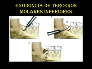 EXODONCIA DE TERCEROS
 MOLARES INFERIORES
 