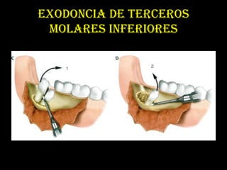 EXODONCIA DE TERCEROS
 MOLARES INFERIORES
 