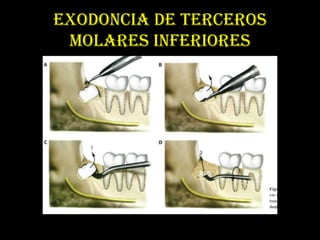 EXODONCIA DE TERCEROS
 MOLARES INFERIORES
 