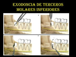 EXODONCIA DE TERCEROS
 MOLARES INFERIORES
 