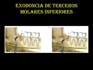 EXODONCIA DE TERCEROS
 MOLARES INFERIORES
 