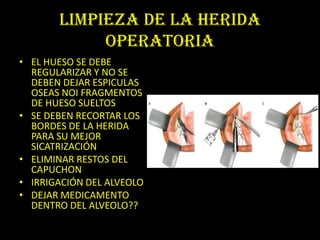 LIMPIEZA DE LA HERIDA
            OPERATORIA
• EL HUESO SE DEBE
  REGULARIZAR Y NO SE
  DEBEN DEJAR ESPICULAS
  OSEAS NOI FRAGMENTOS
  DE HUESO SUELTOS
• SE DEBEN RECORTAR LOS
  BORDES DE LA HERIDA
  PARA SU MEJOR
  SICATRIZACIÓN
• ELIMINAR RESTOS DEL
  CAPUCHON
• IRRIGACIÓN DEL ALVEOLO
• DEJAR MEDICAMENTO
  DENTRO DEL ALVEOLO??
 