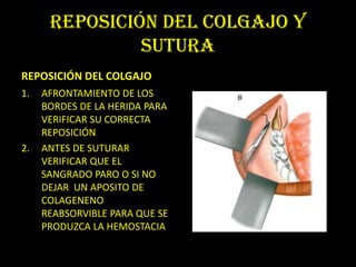 REPOSICIÓN DEL COLGAJO Y
               SUTURA
REPOSICIÓN DEL COLGAJO
1.   AFRONTAMIENTO DE LOS
     BORDES DE LA HERIDA PARA
     VERIFICAR SU CORRECTA
     REPOSICIÓN
2.   ANTES DE SUTURAR
     VERIFICAR QUE EL
     SANGRADO PARO O SI NO
     DEJAR UN APOSITO DE
     COLAGENENO
     REABSORVIBLE PARA QUE SE
     PRODUZCA LA HEMOSTACIA
 
