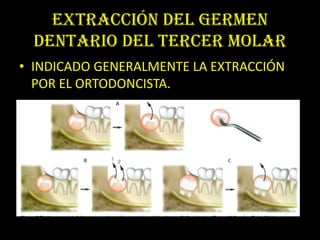 EXTRACCIÓN DEL GERMEN
  DENTARIO DEL TERCER MOLAR
• INDICADO GENERALMENTE LA EXTRACCIÓN
  POR EL ORTODONCISTA.
 