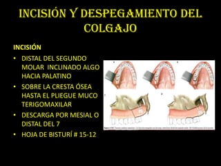 INCISIÓN Y DESPEGAMIENTO DEL
            COLGAJO
INCISIÓN
• DISTAL DEL SEGUNDO
  MOLAR INCLINADO ALGO
  HACIA PALATINO
• SOBRE LA CRESTA ÓSEA
  HASTA EL PLIEGUE MUCO
  TERIGOMAXILAR
• DESCARGA POR MESIAL O
  DISTAL DEL 7
• HOJA DE BISTURÍ # 15-12
 