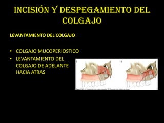 INCISIÓN Y DESPEGAMIENTO DEL
            COLGAJO
LEVANTAMIENTO DEL COLGAJO


• COLGAJO MUCOPERIOSTICO
• LEVANTAMIENTO DEL
  COLGAJO DE ADELANTE
  HACIA ATRAS
 