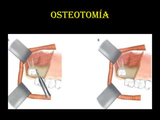 OSTEOTOMÍA
 