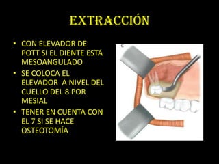 EXTRACCIÓN
• CON ELEVADOR DE
  POTT SI EL DIENTE ESTA
  MESOANGULADO
• SE COLOCA EL
  ELEVADOR A NIVEL DEL
  CUELLO DEL 8 POR
  MESIAL
• TENER EN CUENTA CON
  EL 7 SI SE HACE
  OSTEOTOMÍA
 