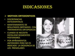 INDICASIONES
 MOTIVOS ORTODONTICOS
• DISCREPANCIAS
  OSTEODENTALES
• MANTENIMIENTO DE
  RESULTADOS OBTENIDOS CON
  TRATAMIENTOS ORTOPEDICOS
• CUANDO SE NECESITA
  DISTALIZAR SEGMENTOS
  POSTERIORES
• POR APIÑAMIENTOS
  ANTERIORES PERO NO ES
  INDICADO LA EXODONCIA DE
  LOS PREMOLARES
 