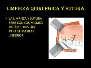 LIMPIEZA QUIRÚRGICA Y SUTURA
• LA LIMPIEZA Y SUTURA
  SERA CON LOS MISMOS
  PARÁMETROS QUE
  PARA EL MAXILAR
  .INFERIOR
 