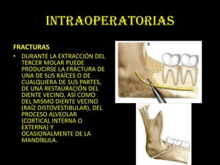 INTRAOPERATORIAS
FRACTURAS
• DURANTE LA EXTRACCIÓN DEL
  TERCER MOLAR PUEDE
  PRODUCIRSE LA FRACTURA DE
  UNA DE SUS RAÍCES O DE
  CUALQUIERA DE SUS PARTES,
  DE UNA RESTAURACIÓN DEL
  DIENTE VECINO, ASÍ COMO
  DEL MISMO DIENTE VECINO
  (RAÍZ DISTOVESTIBULAR), DEL
  PROCESO ALVEOLAR
  (CORTICAL INTERNA O
  EXTERNA) Y
  OCASIONALMENTE DE LA
  MANDÍBULA.
 