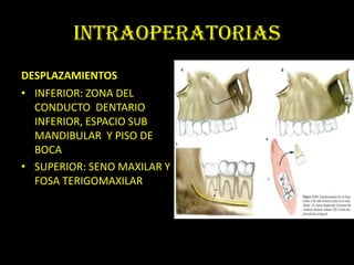 INTRAOPERATORIAS
DESPLAZAMIENTOS
• INFERIOR: ZONA DEL
  CONDUCTO DENTARIO
  INFERIOR, ESPACIO SUB
  MANDIBULAR Y PISO DE
  BOCA
• SUPERIOR: SENO MAXILAR Y
  FOSA TERIGOMAXILAR
 